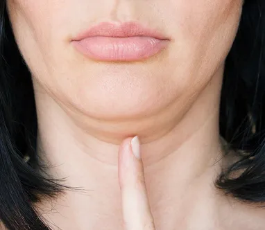 Double Chin