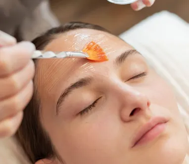 Chemical Peel (Peel hóa học)
